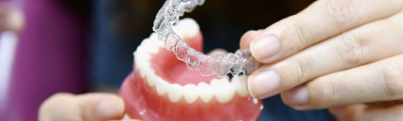 Retencija za zdravljenje nepravilnosti zob